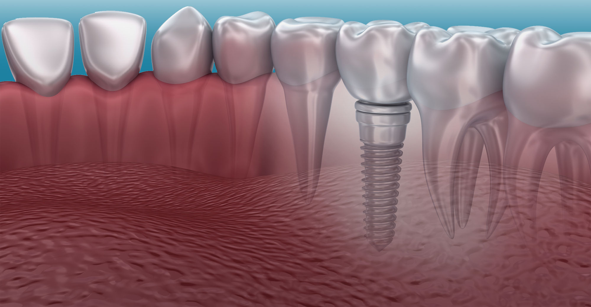 Implant-Slide-001